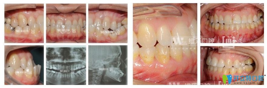 維樂口腔8歲女性地包天矯正前后對(duì)比圖