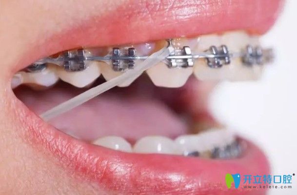 張慧貞醫(yī)生科普：正畸橡皮圈有什么作用？