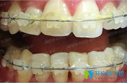 在愛(ài)思特口腔戴陶瓷托槽矯正牙齒術(shù)中照 在愛(ài)思特口腔戴陶瓷托槽矯正牙齒術(shù)中照