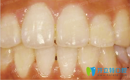 在重慶愛(ài)思特口腔做牙齒矯正后的效果圖 在重慶愛(ài)思特口腔做牙齒矯正后的效果圖