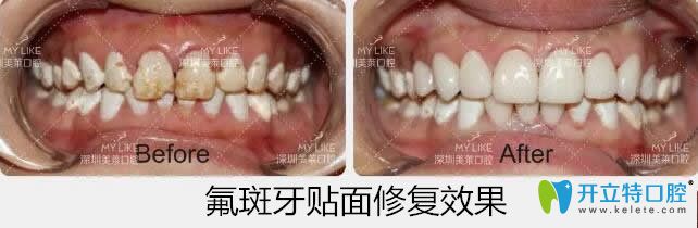 美萊口腔氟斑牙貼面修復案例