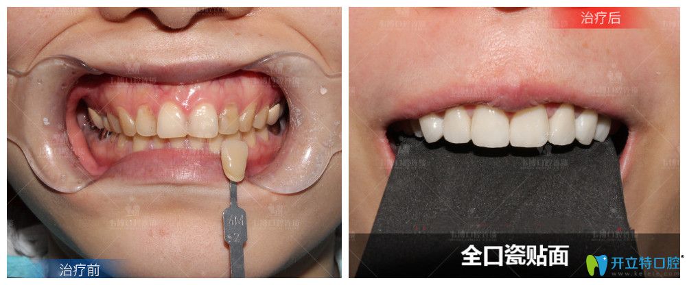 這里有深圳福田下沙韋博口腔瓷貼面美齒效果對(duì)比圖及價(jià)格