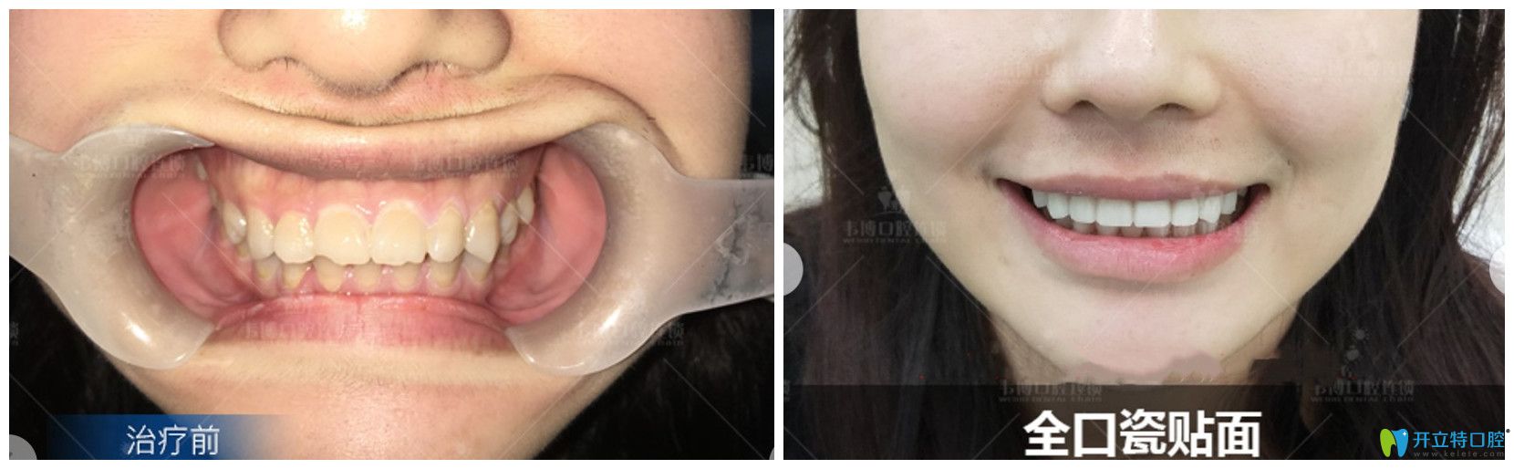 牙齒發(fā)黃，還缺損的小姐姐用瓷貼面來“武裝”牙齒