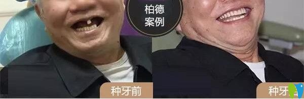 林伯在柏德口腔做的種植牙的前后對比圖