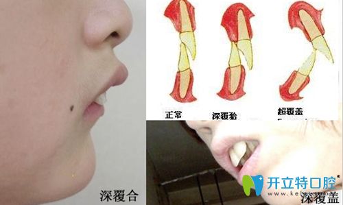 正常牙頜和深覆合及深覆蓋對比圖