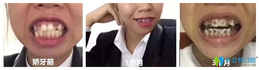 在武漢亞韓做矯正過程中牙齒變化情況圖