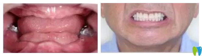 德正口腔全口牙種植案例圖