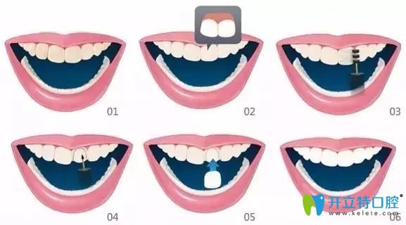 備受追捧的牙齒貼面材料選全瓷、硬質(zhì)和樹脂貼面哪個(gè)好