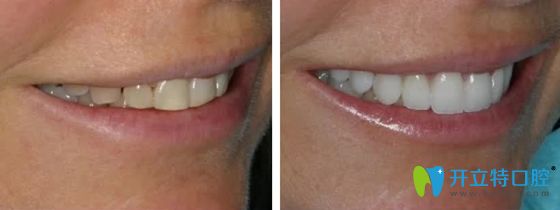 德國(guó)義獲嘉瓷貼面修復(fù)效果圖