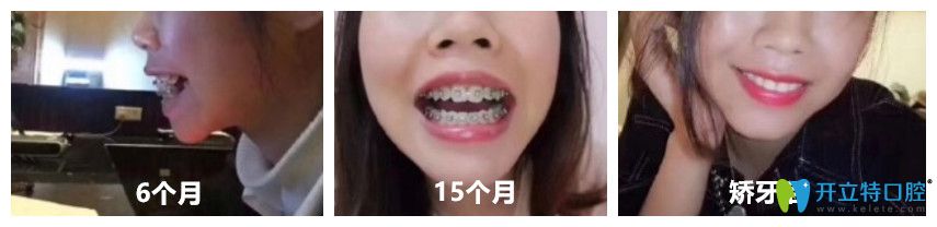 牙齒矯正3個月-下牙套變化圖 