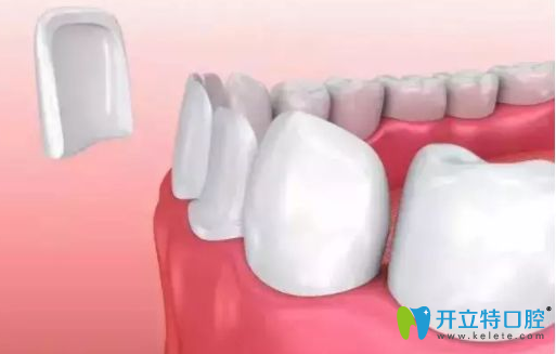 牙齒貼面有后遺癥？千萬別做樹脂牙齒貼面的真相