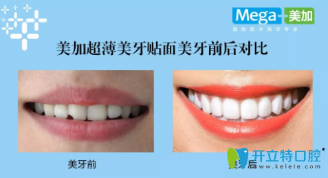 美加超薄貼面前后對(duì)比