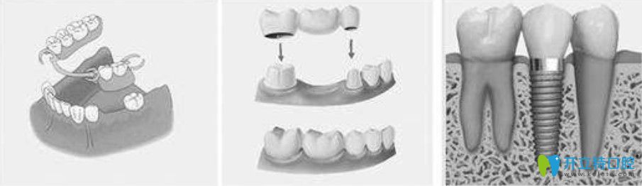 孔紅梅醫(yī)生告訴你種植牙、固定假牙和活動義齒相比有什么區(qū)別