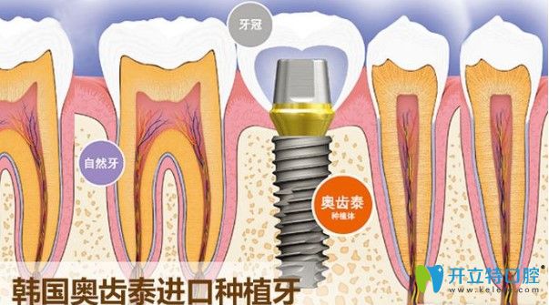 奧齒泰ts好還是gs好