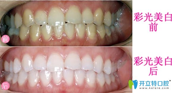 彩光美白牙齒的前后效果圖