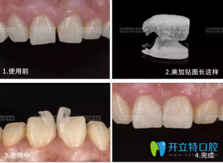 美加超薄貼面的壽命是多久？