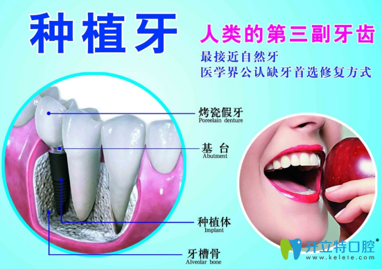 種牙需要時間長?那是沒了解微創(chuàng)種植牙是什么,利弊分析