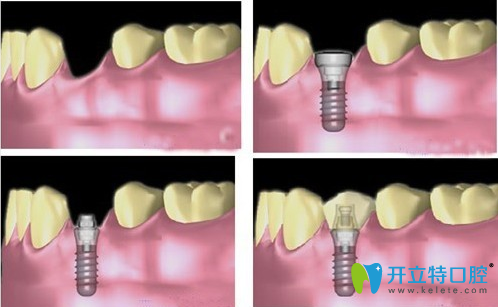 微創(chuàng)種植牙的過程