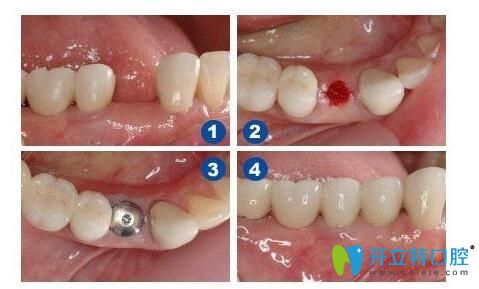 靖江艾齒嘉口腔陳濤醫(yī)生介紹種植牙注意事項(xiàng) 靖江艾齒嘉口腔陳濤醫(yī)生介紹種植牙注意事項(xiàng)