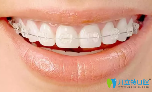 半隱形牙齒矯正明顯嗎？得從隱形和半隱形矯正的區(qū)別說起