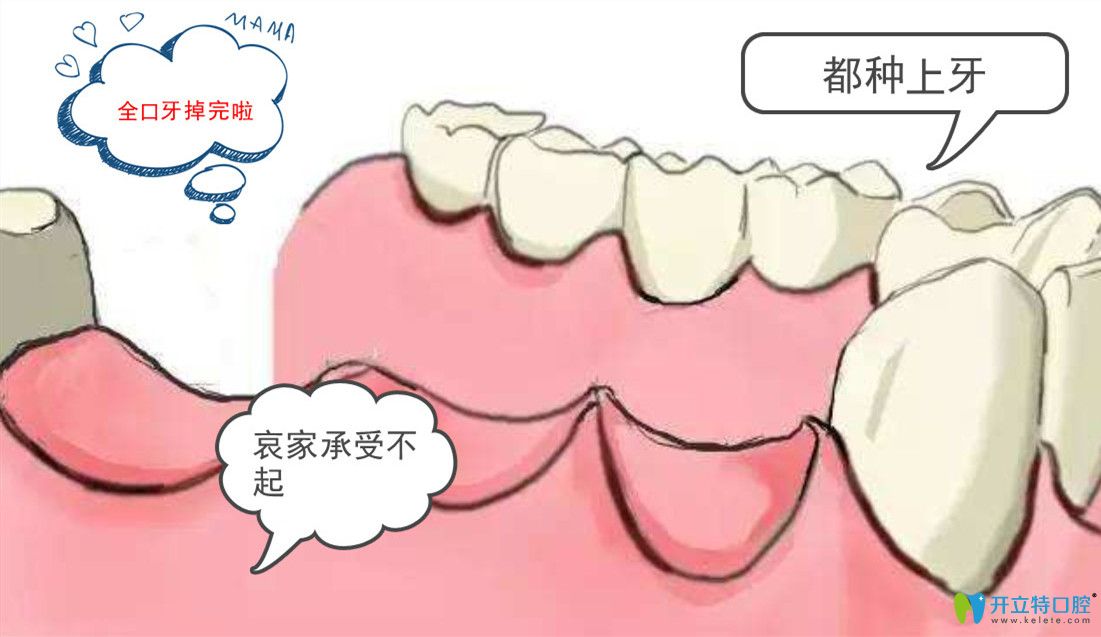 種植全口牙需要種幾顆？諾貝爾全口種植牙8顆多少錢?