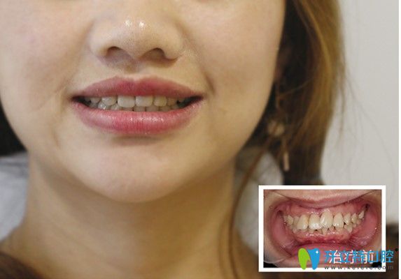 牙齒矯正有辣么厲害嗎？歪牙小姐姐通過正畸重獲整齊牙齒