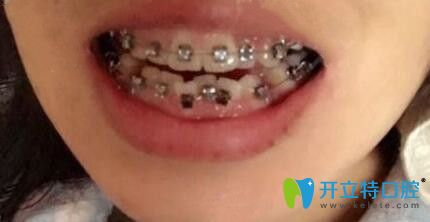 我在中諾口腔剛戴牙套的照片