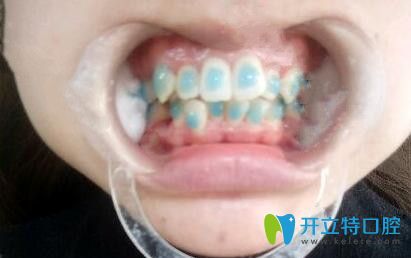 我在石家莊中諾口腔做牙齒矯正粘牙套