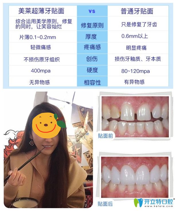 美萊超薄牙貼面你無悔的選擇，小姐姐來曬牙貼面后對比照