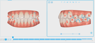 帶隱適美牙套矯正10個(gè)月的效果