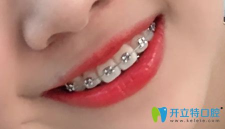 在深圳佳美口腔矯正牙齒一年的效果圖 在深圳佳美口腔矯正牙齒一年的效果圖