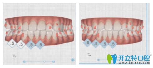 隱適美矯正可預(yù)知矯正效果