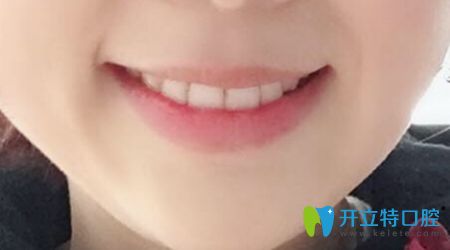 我戴金屬自鎖托槽矯正牙齒后的效果 我戴金屬自鎖托槽矯正牙齒后的效果