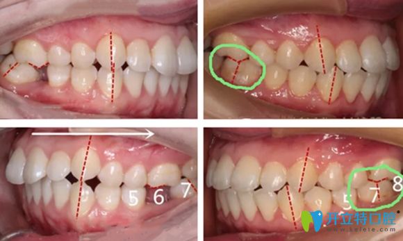 做智齒前移前后效果圖
