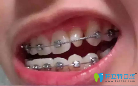 在深圳美佳德口腔矯正牙齒1年半的效果圖