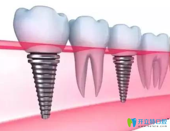 韓國(guó)登騰種植牙很差嗎？