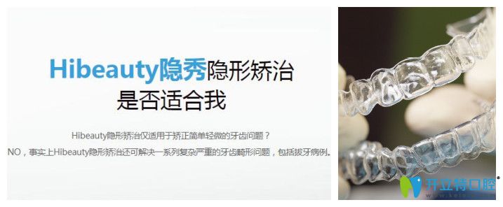 隱秀隱形牙套的優(yōu)勢(shì)