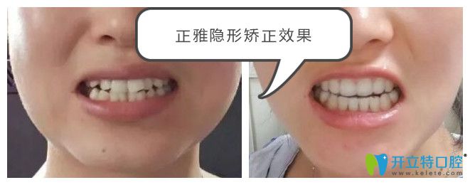 正雅隱形矯正怎么樣