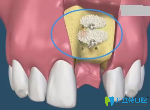 種植牙為何要植骨