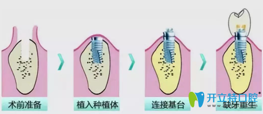 種植牙的過程
