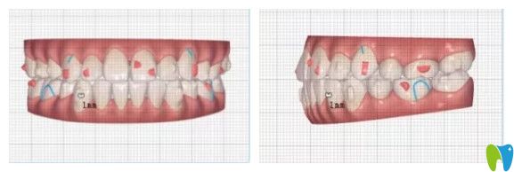 戴隱適美牙套12個(gè)月牙齒情況