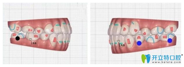 戴隱適美牙套8個(gè)月牙齒情況