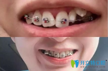 誰(shuí)說(shuō)扭轉(zhuǎn)牙很難矯正,我在深圳美佳德口腔矯正兩年就改善了