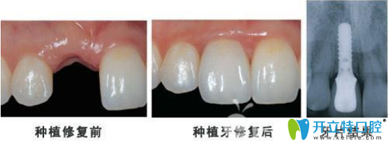 種植牙前后對比