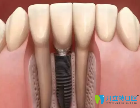 Astra 種植系統(tǒng)怎么樣