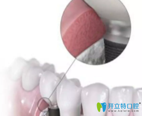 Astra 種植系統(tǒng)3..0mm直徑窄植體