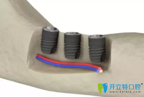 Astra 種植系統(tǒng)6.0mm短植體