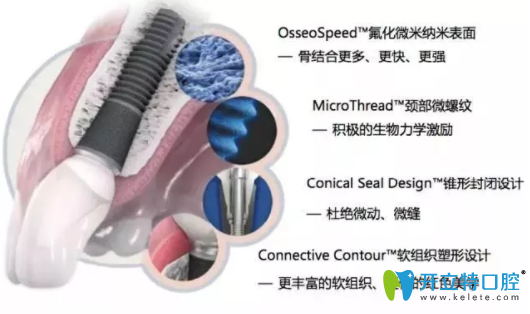 Astra 種植系統(tǒng)的特點有哪些
