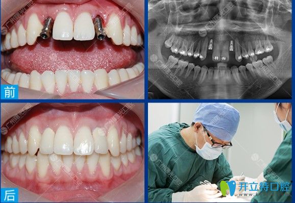 廣州曙光口腔多顆種植牙前后對(duì)比圖