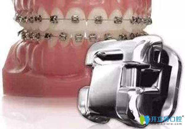 鋼牙和隱適美哪個效果好,探討鋼牙后悔換隱適美的原因